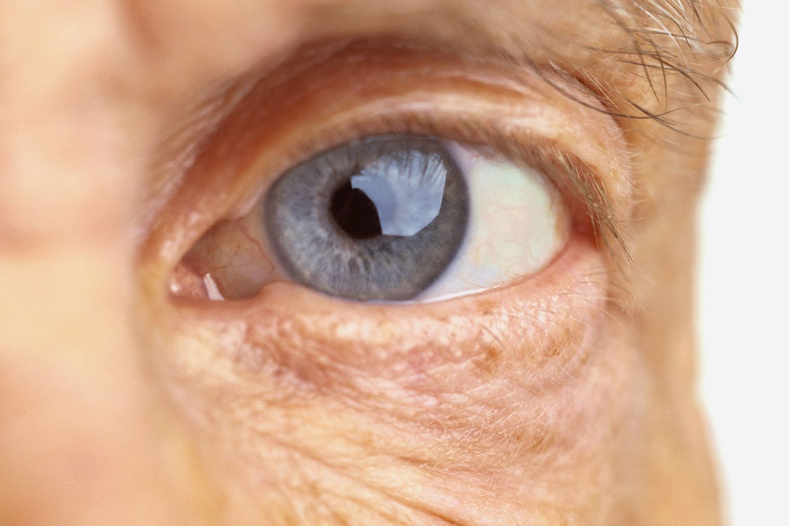 Catarata, sabe o que é?