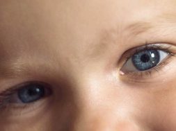 Retinoblastoma