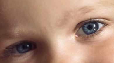 Retinoblastoma